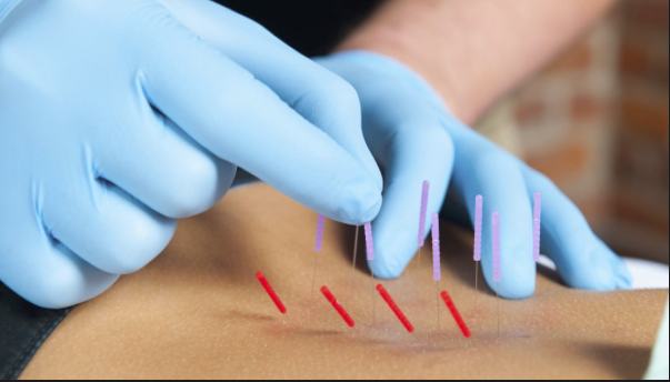 Chiropractic Dry Needling-Course 1-Dallas, TX