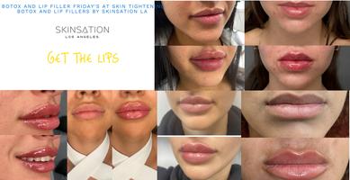 Getting My Skin Tightening, Botox And Lip Fillers By Skinsation La - Hillley To Work thumbnail