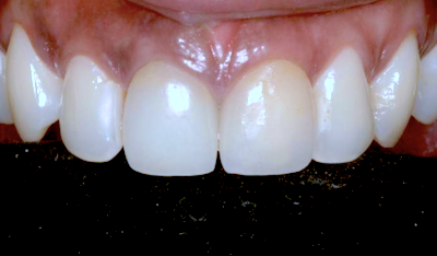 New Course: Digital Workflow for Esthetic All Ceramic Restorations