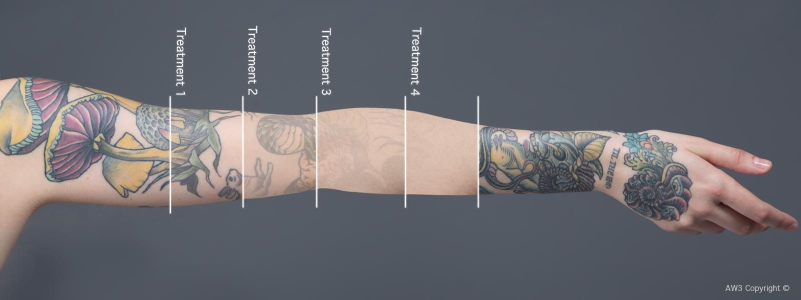 Redink Tattoo Studio Laser Tattoo Removal Free consultation